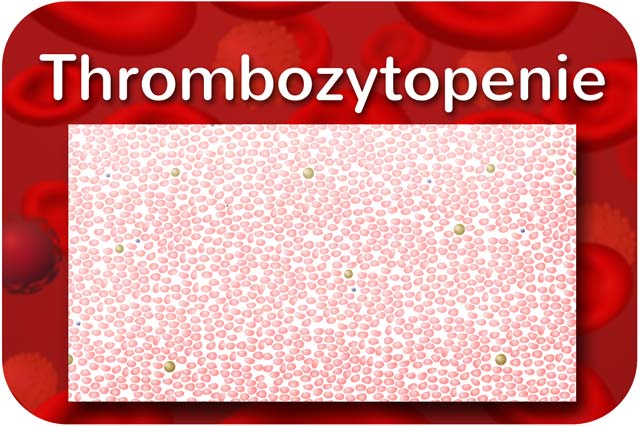 Thrombozytopenie / Thrombopenie: zu wenig Thrombozyten