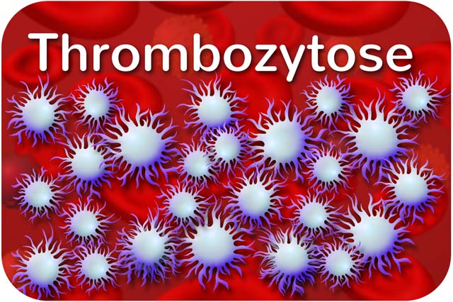 Thrombozytose: zu viele Thrombozyten