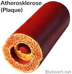 Atherosklerose: Blutgefäß mit Plaque