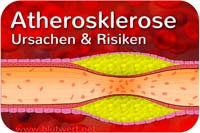 Atherosklerose: Ursache und Risiken