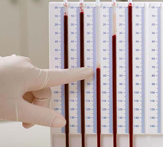 Blutsenkungsgeschwindigkeit messen im Labor