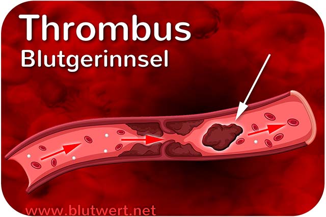 Thrombus (Blutgerinnsel)