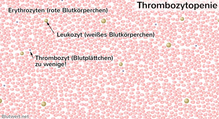 Thrombozytopenie: zu wenige Thrombozyten im Blut